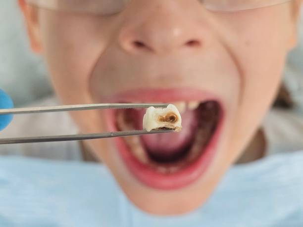 Best Emergency Tooth Extraction  in Burton, SC
